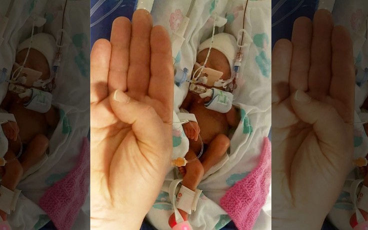 Sức sống phi thường của em bé sinh non nhỏ hơn bàn tay