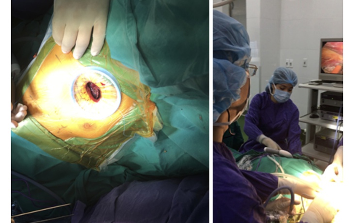 Lần đầu tiên tại Việt Nam phẫu thuật cắt u phổi không cần thở máy hỗ trợ