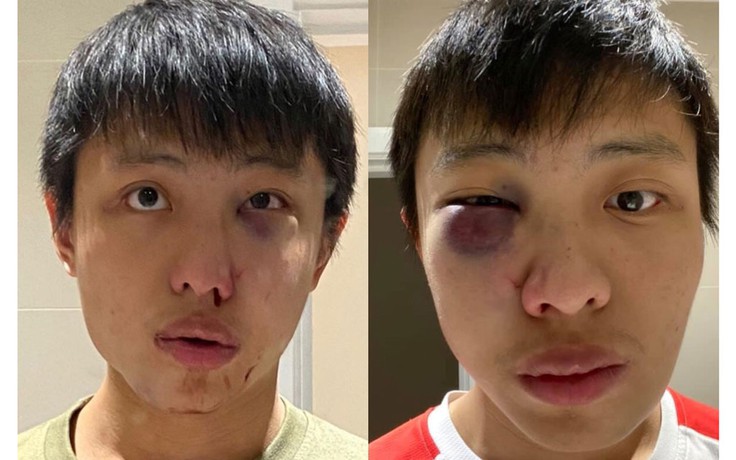 Dân mạng phẫn nộ chuyện chàng trai Singapore ở Anh bị đánh bầm mắt vì dịch Covid-19