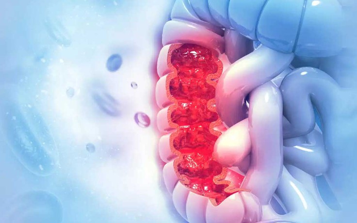 Hay bị đầy hơi sau khi ăn: Đừng chủ quan vì có thể là ung thư ruột