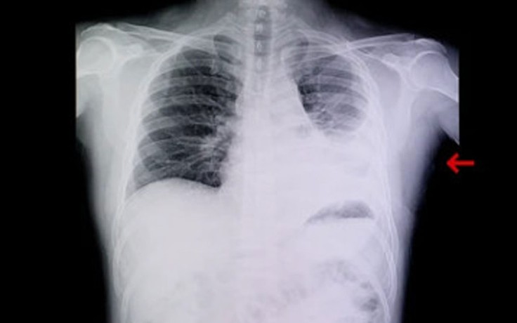Làm sao để phòng tránh bệnh viêm phổi trong mùa lạnh?