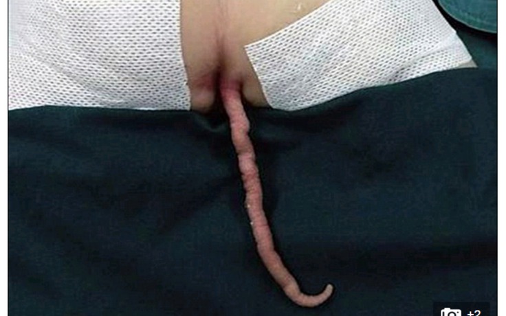 Cậu bé mọc đuôi dài 15 cm ở Trung Quốc