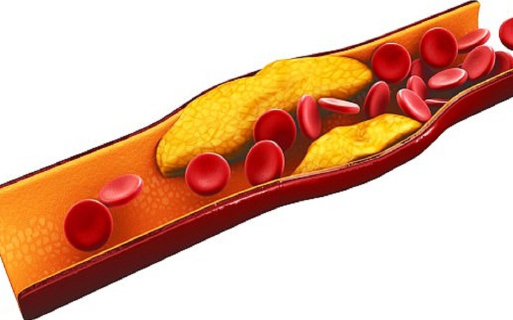 Có thể ‘đảo ngược’ tiến trình bệnh xơ vữa động mạch chỉ với 1 liều thuốc