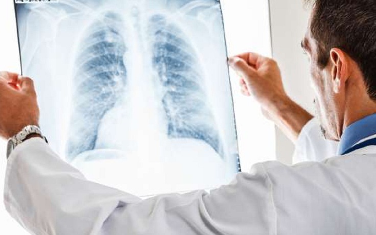 4 thói quen gây tổn hại phổi mà nhiều người không biết
