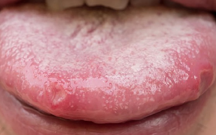 9 bệnh nhân Covid-19 ở Mỹ bị biến chứng lưỡi phình to dị thường