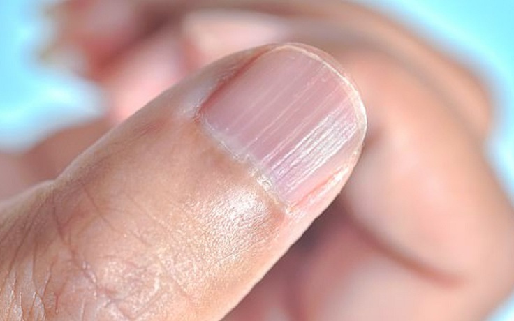 Nổi lằn đỏ trên móng tay, 3 năm sau người phụ nữ mới biết bị ung thư