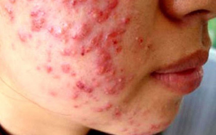 Cảnh báo chất bảo quản mỹ phẩm gây dị ứng