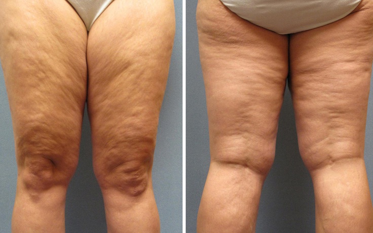 Tình trạng Cellulite - Sần da cam và cách phòng trị