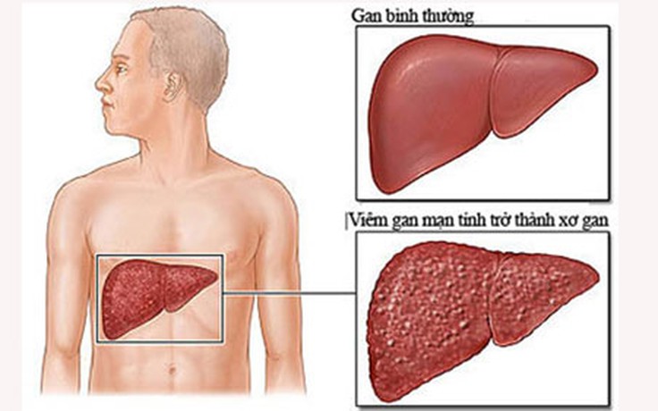 Đừng để viêm gan làm giảm chất lượng sống