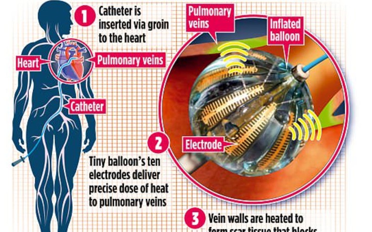 Công nghệ mới có thể điều trị cho hàng ngàn người bị rối loạn nhịp tim