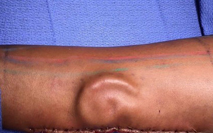 Nuôi cấy tai trong cánh tay của bệnh nhân