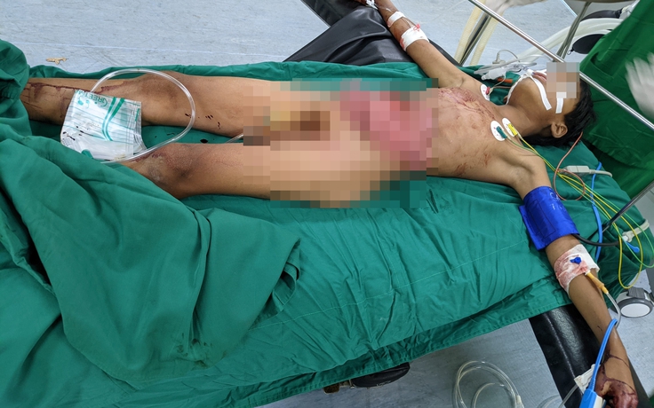 Kon Tum: Cứu sống bệnh nhân 14 tuổi gặp tai nạn lòi nội tạng ra ngoài