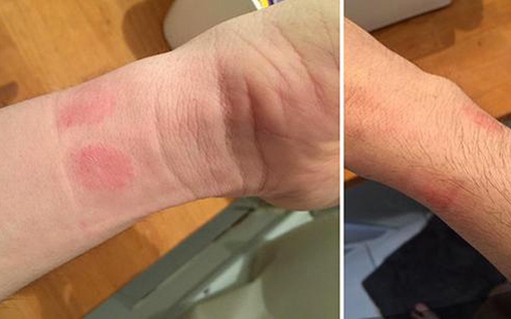 Người dùng bị dị ứng da khi đeo Apple Watch