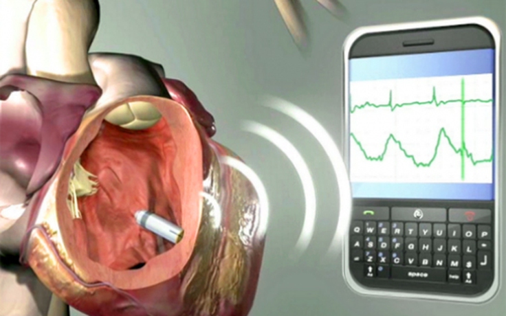 Smartphone làm rối loạn máy điều hòa nhịp tim
