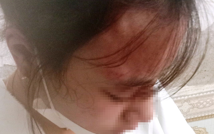 Hà Tĩnh: Một nữ sinh lớp 10 bị hàng xóm hành hung đến ‘chấn động não’