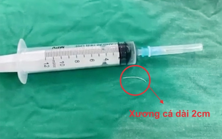 Người đàn ông bị hóc xương cá xuyên thủng lưỡi Người đàn ông bị hóc xương cá xuyên thủng lưỡi