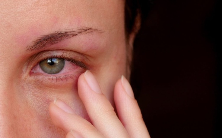 Vì sao nhựa khoai môn có thể gây dị ứng, làm đau mắt?
