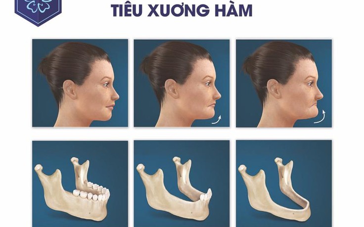 Tại sao không nên trì hoãn trồng răng implant?