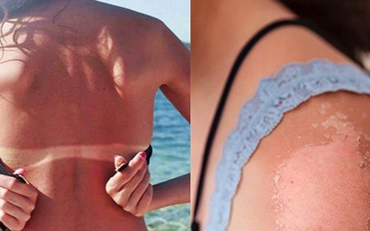 5 điều tuyệt đối không được làm khi làn da bị cháy nắng