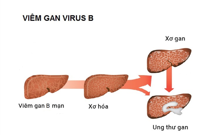 Cảnh báo biến chứng xơ gan do viêm gan virus