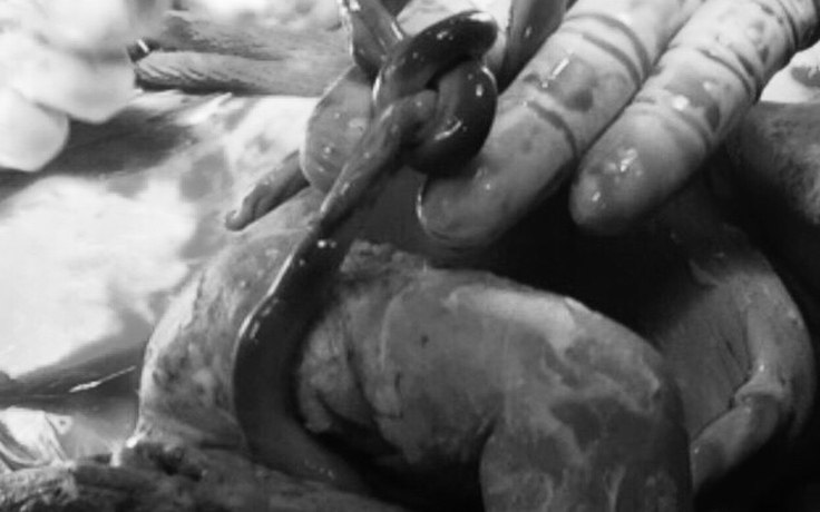 Phương Châu Sa Đéc cứu sống thai nhi từ nút thắt dây rốn sinh tử