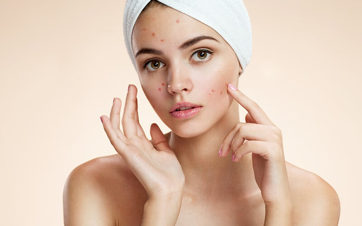 Mẹo skincare giúp trị thâm mụn hiệu quả?