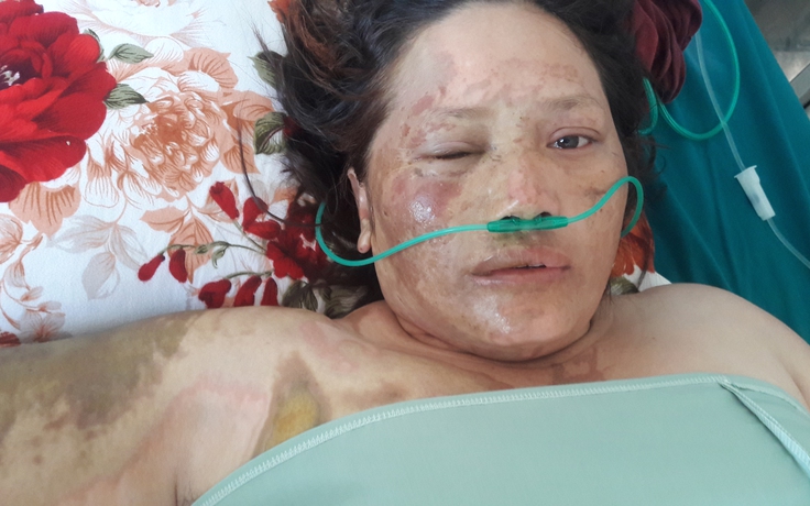 Một phụ nữ bị tạt axit vào người, bỏng nặng