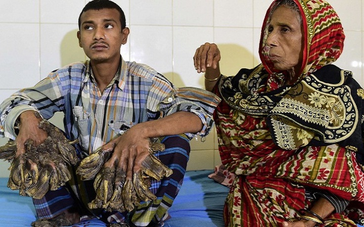 ‘Người cây’ Bangladesh phải nhập viện vì sức khỏe sa sút