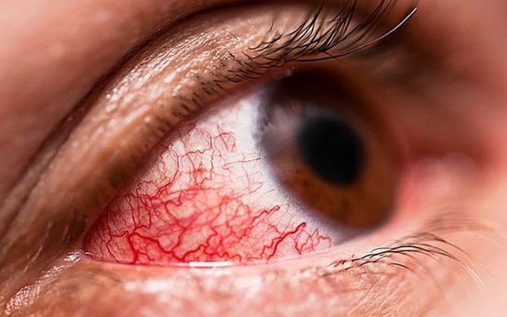 Virus gây xuất huyết ở mắt lan đến châu Âu, tỷ lệ tử vong đến 40%