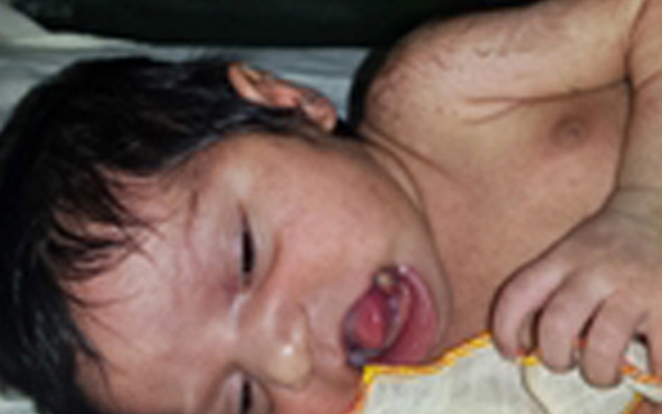 Bào thai sinh đôi trong miệng trẻ sơ sinh