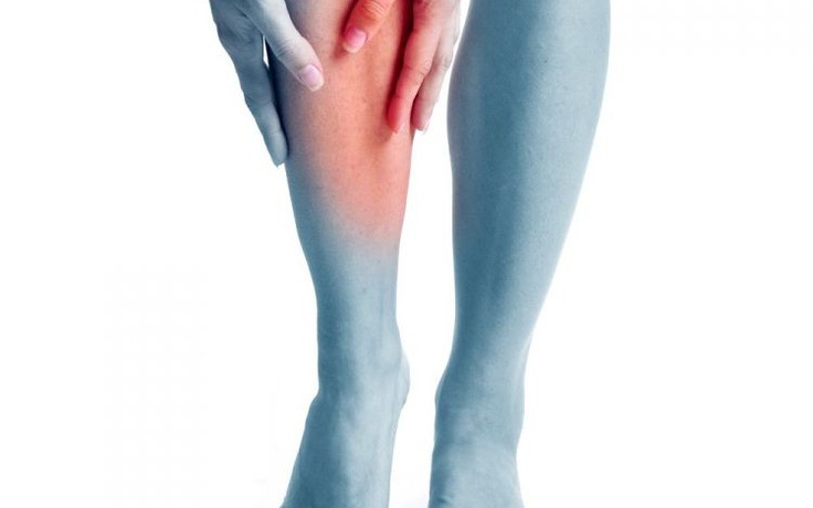 Nữ giới nên biết về bệnh giãn tĩnh mạch