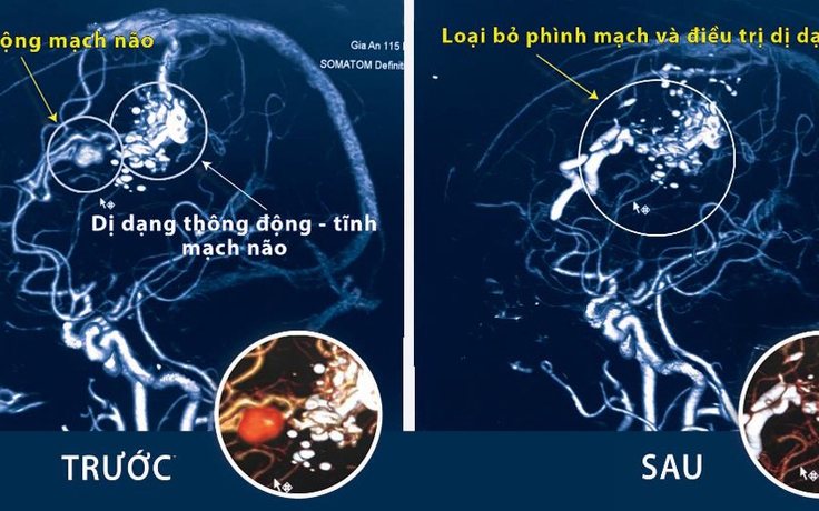 Đột ngột đau đầu dữ dội, coi chừng đột quỵ, xuất huyết màng não