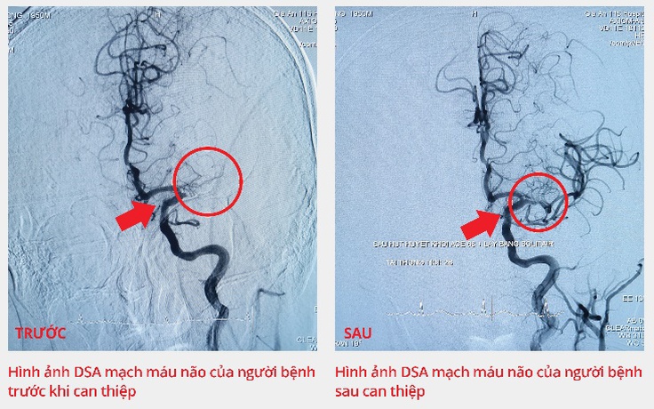 Chụp mạch máu não cứu bệnh nhân đột quỵ