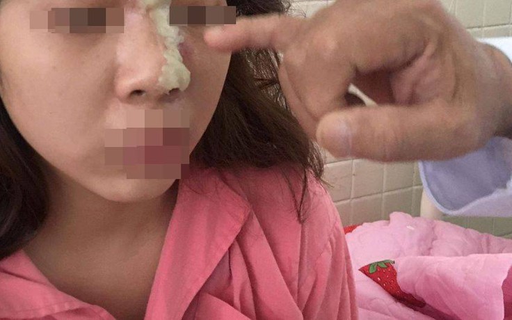 Cô gái trẻ bị mù mắt sau tiêm filler nâng mũi tại spa