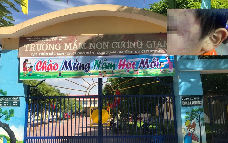 Hà Tĩnh: Con gái giáo viên vào trường mầm non đánh bé trai bầm tím mặt