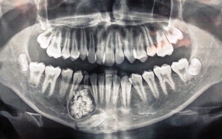 Mổ thành công ca u răng hiếm gặp, lấy ra 100 cái răng trong khối u