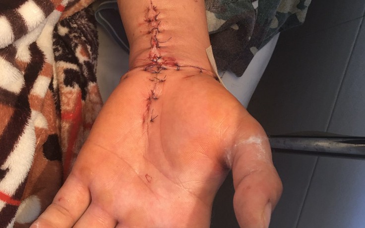 Nối thành công bàn tay bị đứt lìa cho một bệnh nhân