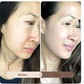 Liệu pháp peel da an toàn được chuyên gia tin tưởng, thay thế filler và botox