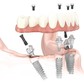 Trồng răng Implant toàn hàm, nâng cao sức khỏe, nâng cao chất lượng cuộc sống