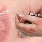 Cứ nghĩ sẹo bỏng phải xâm lấn nhưng dùng kem mờ sẹo vẫn hiệu quả nhanh chóng