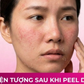 Cần làm gì sau khi peel da? Bất ngờ 99% đều làm sai khiến da tổn thương