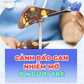 Cảnh báo gan nhiễm mỡ ở người trẻ