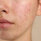 Kháng kháng sinh trong điều trị mụn và giải pháp thay thế từ tia Plasma lạnh