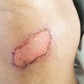 Vết loét lâu lành và nguy cơ hoại tử, dừng ngay việc tự xử lý tại nhà