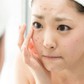 Cách trị thâm mụn tuổi dậy thì: Không biết sớm khiến nhiều bạn tự ti làn da