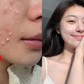 Top 4 kem chấm mụn ‘dập ổ mụn hiệu quả’ sáng dậy xẹp mụn không lo sẹo