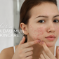 Da dầu mụn, lỗ chân lông to có cần dưỡng ẩm mùa nắng nóng đỉnh điểm không?