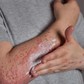Gia tăng bệnh da liễu mùa mưa ẩm và hệ lụy từ thói quen tự điều trị