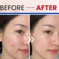 Top 5 kem chấm mụn giúp mụn viêm sưng xẹp sau khoảng 1 đêm ngừa sẹo thâm
