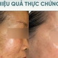 Top 5 kem mờ nám hiệu quả với cả hỗn hợp lâu năm, hết hàng liên tục